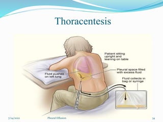 Thoracentesis
7/24/2022 34
Pleural Effusion
 