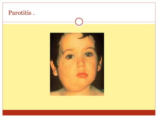1. Mumps (parotitis).ppt