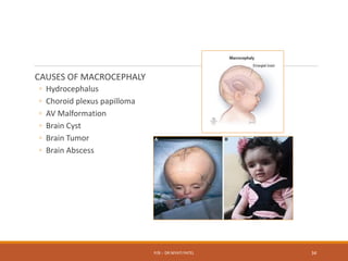 CAUSES OF MACROCEPHALY
◦ Hydrocephalus
◦ Choroid plexus papilloma
◦ AV Malformation
◦ Brain Cyst
◦ Brain Tumor
◦ Brain Abscess
P/B :- DR NIYATI PATEL 34
 