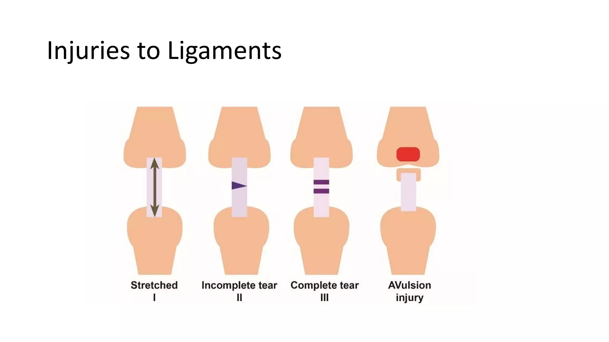 Fractures: Definiton, Diagnosis, Fracture healing , Complications.pptx