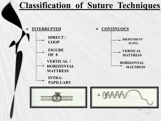 Classification of Suture Techniques
 INTERRUPTED  CONTINUOUS
IDEPENDENT
SLING
VERTICAL
MATTRESS
HORIZONTAL
MATTRESS
DIRECT /
LOOP
FIGURE
OF 8
VERTICAL /
HORIZONTAL
MATTRESS
INTRA-
PAPILLARY
 