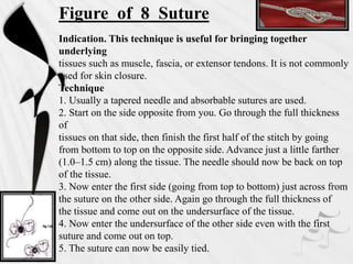 Figure of 8 Suture
Indication. This technique is useful for bringing together
underlying
tissues such as muscle, fascia, or extensor tendons. It is not commonly
used for skin closure.
Technique
1. Usually a tapered needle and absorbable sutures are used.
2. Start on the side opposite from you. Go through the full thickness
of
tissues on that side, then finish the first half of the stitch by going
from bottom to top on the opposite side. Advance just a little farther
(1.0–1.5 cm) along the tissue. The needle should now be back on top
of the tissue.
3. Now enter the first side (going from top to bottom) just across from
the suture on the other side. Again go through the full thickness of
the tissue and come out on the undersurface of the tissue.
4. Now enter the undersurface of the other side even with the first
suture and come out on top.
5. The suture can now be easily tied.
 