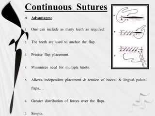 Continuous Sutures
 Advantages:
1. One can include as many teeth as required.
2. The teeth are used to anchor the flap.
3. Precise flap placement.
4. Minimizes need for multiple knots.
5. Allows independent placement & tension of buccal & lingual/ palatal
flaps….
6. Greater distribution of forces over the flaps.
7. Simple.
 