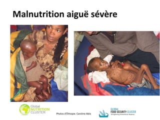 Malnutrition aiguë sévère
Photos d'Éthiopie. Caroline Abla
 