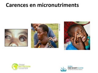Carences en micronutriments
 