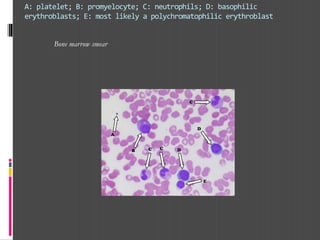 A: platelet; B: promyelocyte; C: neutrophils; D: basophilic
erythroblasts; E: most likely a polychromatophilic erythroblast
Bone marrow smear
 