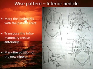 Wise pattern – Inferior pedicle
• Mark the landmarks
with the patient erect.
• Transpose the infra-
mammary crease
anteriorly.
• Mark the position of
the new nipple.
102
 