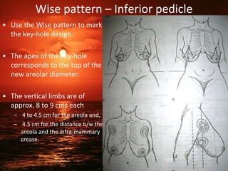 Wise pattern – Inferior pedicle
• Use the Wise pattern to mark
the key-hole design.
• The apex of the key-hole
corresponds to the top of the
new areolar diameter.
• The vertical limbs are of
approx. 8 to 9 cms each
– 4 to 4.5 cm for the areola and,
– 4.5 cm for the distance b/w the
areola and the infra-mammary
crease.
103
 