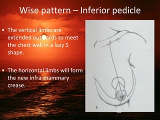 Wise pattern – Inferior pedicle
• The vertical limbs are
extended outwards to meet
the chest wall in a lazy S
shape.
• The horizontal limbs will form
the new infra-mammary
crease.
104
 