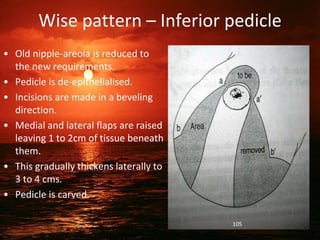 Wise pattern – Inferior pedicle
• Old nipple-areola is reduced to
the new requirements.
• Pedicle is de-epithelialised.
• Incisions are made in a beveling
direction.
• Medial and lateral flaps are raised
leaving 1 to 2cm of tissue beneath
them.
• This gradually thickens laterally to
3 to 4 cms.
• Pedicle is carved.
105
 