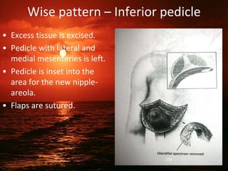 Wise pattern – Inferior pedicle
• Excess tissue is excised.
• Pedicle with lateral and
medial mesenteries is left.
• Pedicle is inset into the
area for the new nipple-
areola.
• Flaps are sutured.
106
 