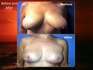 Before and
After
107
 
