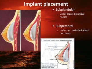 Implant placement
• Subglandular
– Under breast but above
muscle
• Subpectoral
– Under pec. major but above
pec. minor
31
 