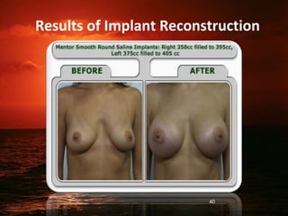 Results of Implant Reconstruction
40
 