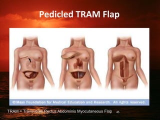 Pedicled TRAM Flap
TRAM = Transverse Rectus Abdominis Myocutaneous Flap 45
 