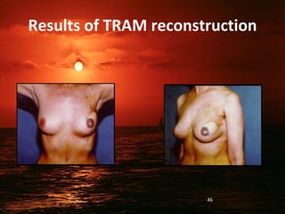 Results of TRAM reconstruction
46
 