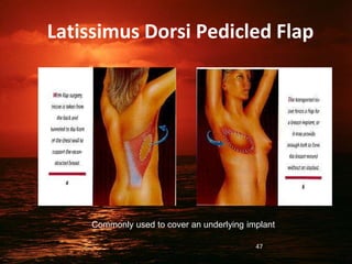 Latissimus Dorsi Pedicled Flap
Commonly used to cover an underlying implant
47
 