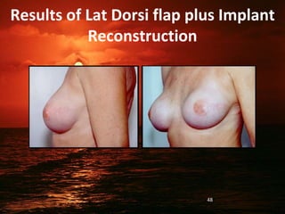 Results of Lat Dorsi flap plus Implant
Reconstruction
48
 