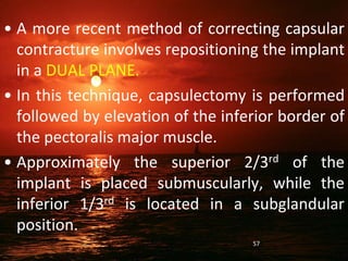 • A more recent method of correcting capsular
contracture involves repositioning the implant
in a DUAL PLANE.
• In this technique, capsulectomy is performed
followed by elevation of the inferior border of
the pectoralis major muscle.
• Approximately the superior 2/3rd of the
implant is placed submuscularly, while the
inferior 1/3rd is located in a subglandular
position.
57
 