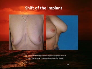 Shift of the implant
An example of wrong inserted implant under the muscle
after the surgery – a double fold under the breast
65
 