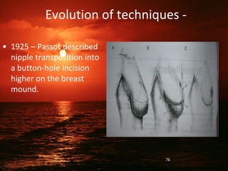 Evolution of techniques -
• 1925 – Passot described
nipple transposition into
a button-hole incision
higher on the breast
mound.
76
 
