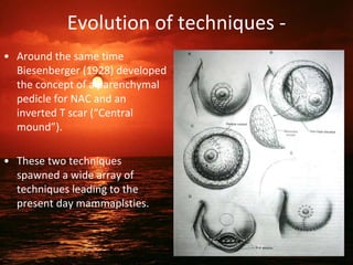 Evolution of techniques -
• Around the same time
Biesenberger (1928) developed
the concept of a parenchymal
pedicle for NAC and an
inverted T scar (“Central
mound”).
• These two techniques
spawned a wide array of
techniques leading to the
present day mammaplsties.
77
 