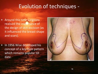 Evolution of techniques -
• Around this time surgeons
realised the importance of
the design of skin excision (as
it influenced the breast shape
and scars).
• In 1956 Wise developed his
concept of a key-hole pattern
which remains popular till
date.
78
 