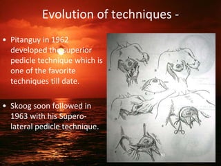 Evolution of techniques -
• Pitanguy in 1962
developed the superior
pedicle technique which is
one of the favorite
techniques till date.
• Skoog soon followed in
1963 with his Supero-
lateral pedicle technique.
80
 