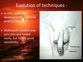 Evolution of techniques -
• In 1972 McKissock
developed his vertical bi-
pedicle flap.
• McKissock’s pedicle was
very thin and folded
easily, but lacked good
vascularity.
81
 