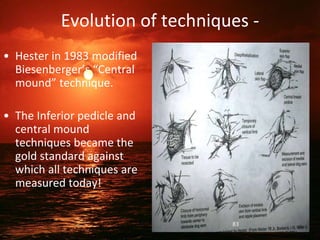 Evolution of techniques -
• Hester in 1983 modified
Biesenberger’s “Central
mound” technique.
• The Inferior pedicle and
central mound
techniques became the
gold standard against
which all techniques are
measured today!
83
 