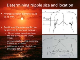 Determining Nipple size and location
• Average areolar diameter is 38
to 45 mm.
• Position of the new nipple can
be derived by various means –
– 21 cms below sternal notch on
the mid-clavicular line (Penn,
1955).
– Average nipple to infra-mammary
fold distance = 7cms.
– Mid-humeral point plus 2-3 cms
(Pitanguy, 1967).
85
 