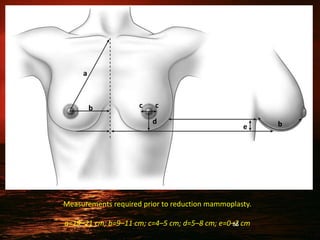 Measurements required prior to reduction mammoplasty.
a=19–21 cm; b=9–11 cm; c=4–5 cm; d=5–8 cm; e=0–2 cm
a
b c c
d
e b
86
 