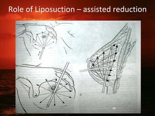 Role of Liposuction – assisted reduction
88
 