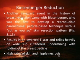 Biesenberger Reduction
• Another vanguard event in the history of
breast reduction came with Biesenberger, who
was the first to develop a reproducible
parenchymal pedicle-based technique with a
“cut as you go” skin resection pattern (Fig.
8.1.3)
• Results in an inverted-T scar and relies heavily
on wide sub cutaneous undermining with
folding of the breast pedicle
• High rates of skin and nipple necrosis
91
 