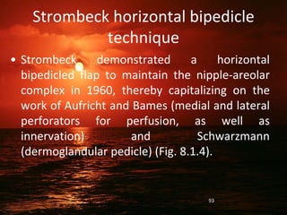 Strombeck horizontal bipedicle
technique
• Strombeck demonstrated a horizontal
bipedicled flap to maintain the nipple-areolar
complex in 1960, thereby capitalizing on the
work of Aufricht and Bames (medial and lateral
perforators for perfusion, as well as
innervation) and Schwarzmann
(dermoglandular pedicle) (Fig. 8.1.4).
93
 