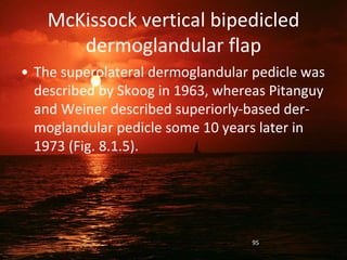 McKissock vertical bipedicled
dermoglandular flap
• The superolateral dermoglandular pedicle was
described by Skoog in 1963, whereas Pitanguy
and Weiner described superiorly-based der-
moglandular pedicle some 10 years later in
1973 (Fig. 8.1.5).
95
 