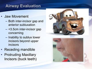 Airway Evaluation
• Jaw Movement
– Both inter-incisor gap and
anterior subluxation
– <3.5cm inter-incisor gap
concerning
– Inability to sublux lower
incisors beyond upper
incisors
• Receding mandible
• Protruding Maxillary
Incisors (buck teeth)
 