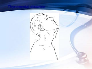 Thyromental distance
 