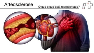 Arteosclerose O que é que está representado?
 