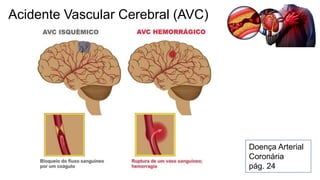 Acidente Vascular Cerebral (AVC)
Doença Arterial
Coronária
pág. 24
 