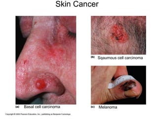 Basal cell carcinoma
Sqaumous cell carcinoma
Melanoma
Skin Cancer
 