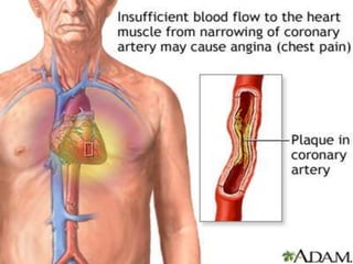Antianginal drug