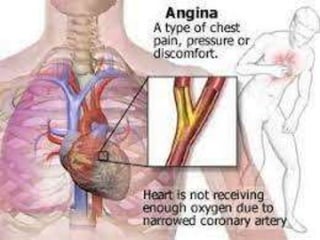Antianginal drug