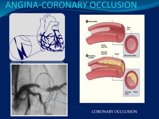 ANGINA-CORONARY OCCLUSION
CORONARY OCCLUSION
 