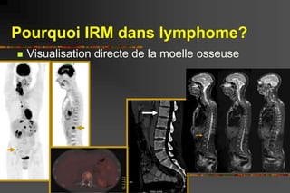 Moelle osseuse - Lymphome
 L’IRM peut détecter des sites occultes
chez 1/3 des patients avec biopsies
médullaires négativ...