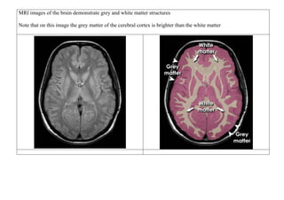 MRI images of the brain demonstrate grey and white matter structures
Note that on this image the grey matter of the cerebral cortex is brighter than the white matter
 