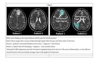 Clinical
Relate your findings to the clinical features and the specific clinical question
Both of these images show an area of abnormal high signal within the grey and white matter of the brain
Patient 1: gradually worsening headaches and seizures – diagnosis = brain tumour
Patient 2: sudden onset left hemiplegia – diagnosis = acute cerebral infarct
Although the MRI appearances provide information regarding the position and size of the areas of abnormality, it is the different
clinical histories which provide the strongest clues to the diagnosis in both cases
 