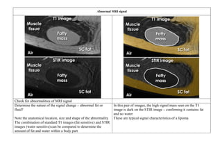 Abnormal MRI signal
Check for abnormalities of MRI signal
Determine the nature of the signal change – abnormal fat or
fluid?
Note the anatomical location, size and shape of the abnormality
The combination of standard T1 images (fat sensitive) and STIR
images (water sensitive) can be compared to determine the
amount of fat and water within a body part
In this pair of images, the high signal mass seen on the T1
image is dark on the STIR image – confirming it contains fat
and no water
These are typical signal characteristics of a lipoma
 