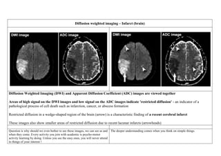Diffusion weighted imaging – Infarct (brain)
Diffusion Weighted Imaging (DWI) and Apparent Diffusion Coefficient (ADC) images are viewed together
Areas of high signal on the DWI images and low signal on the ADC images indicate 'restricted diffusion' - an indicator of a
pathological process of cell death such as infarction, cancer, or abscess formation
Restricted diffusion in a wedge-shaped region of the brain (arrow) is a characteristic finding of a recent cerebral infarct
These images also show smaller areas of restricted diffusion due to recent lacunar infarcts (arrowheads)
Question is why should we even bother to see these images, we can see as and
when they come. Every activity you join with academic is psycho-motor
activity learning by doing. Unless you see the easy ones, you will never attend
to things of your interest !
The deeper understanding comes when you think on simple things.
 