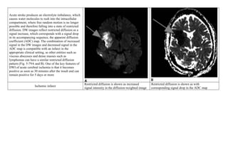 Acute stroke produces an electrolyte imbalance, which
causes water molecules to rush into the intracellular
compartment, where free random motion is no longer
possible and therefore falling into a state of restricted
diffusion. DW images reflect restricted diffusion as a
signal increase, which corresponds with a signal drop
in its accompanying sequence, the apparent diffusion
coefficient (ADC) map. The combination of increased
signal in the DW images and decreased signal in the
ADC map is compatible with an infarct in the
appropriate clinical setting, as other entities such as
viscous abscesses and dense masses such as
lymphomas can have a similar restricted diffusion
pattern (Fig. 5-79A and B). One of the key features of
DWI of acute cerebral ischemia is that it becomes
positive as soon as 30 minutes after the insult and can
remain positive for 5 days or more
Ischemic infarct
Restricted diffusion is shown as increased
signal intensity in the diffusion-weighted image
Restricted diffusion is shown as with
corresponding signal drop in the ADC map
 